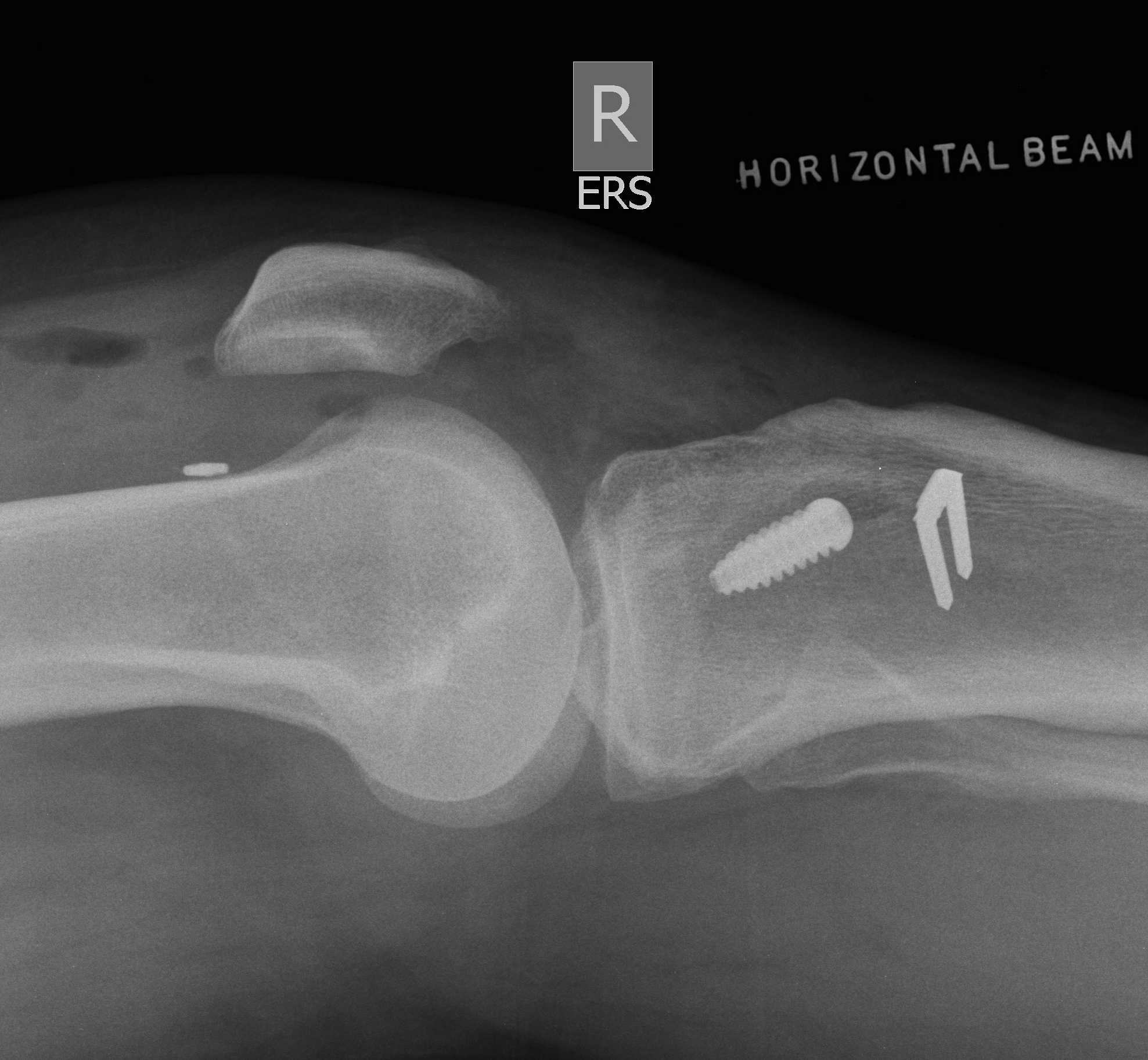 ACL Reconstruction Lateral